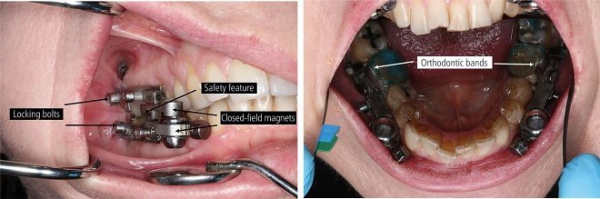 Радикальное устройство для похудения DentalSlim в прямом смысле закроет человеку рот