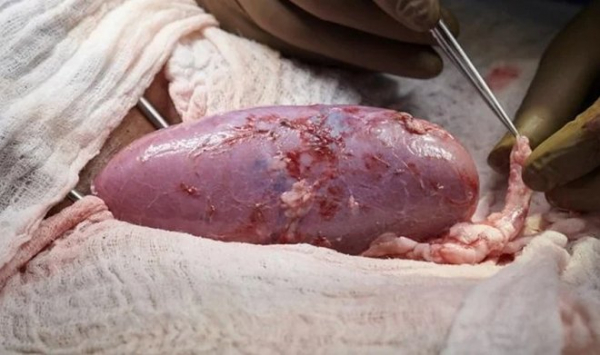 В США проведена первая успешная трансплантация свиной почки человеку