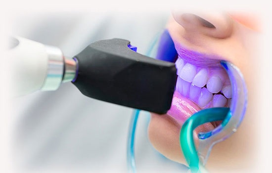 Эффективное отбеливание зубов в стоматологической клинике