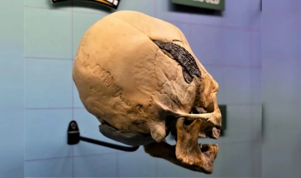 Перуанский череп со сложным металлическим имплантом вызвал споры ученых