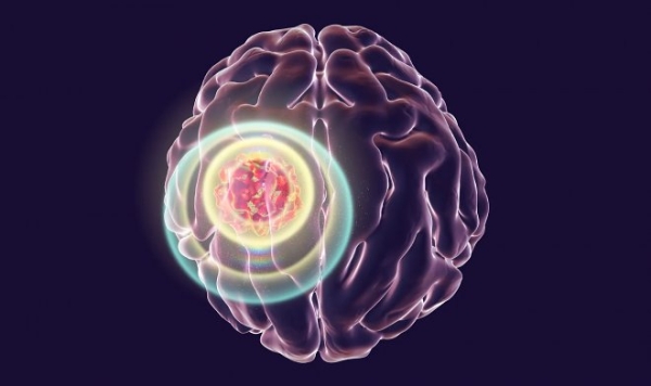 Инфракрасный имплант в черепе эффективно борется с раком мозга