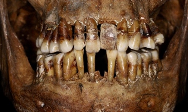 Зубные протезы 17-го века спасли репутацию многих французских аристократов