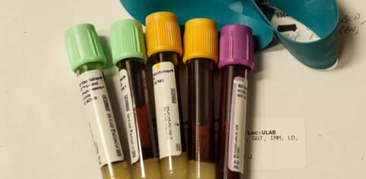 В Стэнфорде разработали анализ крови для определения скорости старения отдельных органов