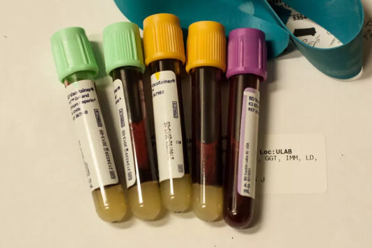 В Стэнфорде разработали анализ крови для определения скорости старения отдельных органов