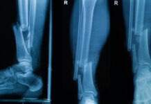 Клеевой пистолет позволит печатать заплатки для сломанных костей прямо во время операции