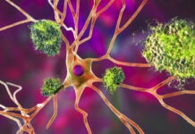 Белок-«виновник» Альцгеймера подзаряжает иммунные клетки и резко снижает риск рака