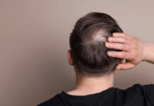 В США завершаются испытания первой эффективной таблетки от облысения