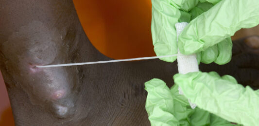 Человечество в шаге от полной победы над второй (после оспы) инфекционной болезнью в истории